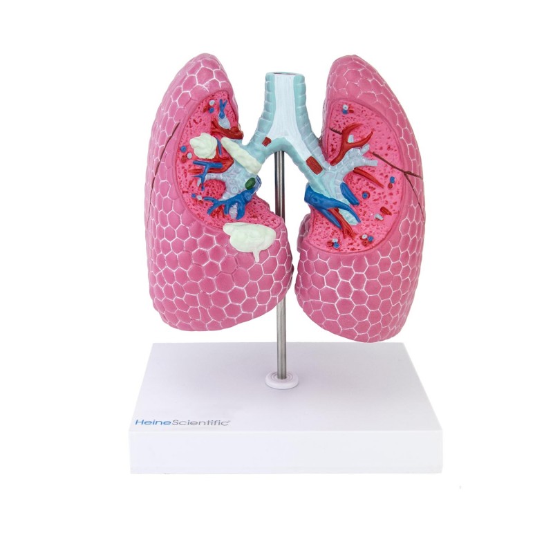 Model chorób płuc HeineScientific